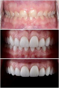  Before and after orthodontic treatment and restoration