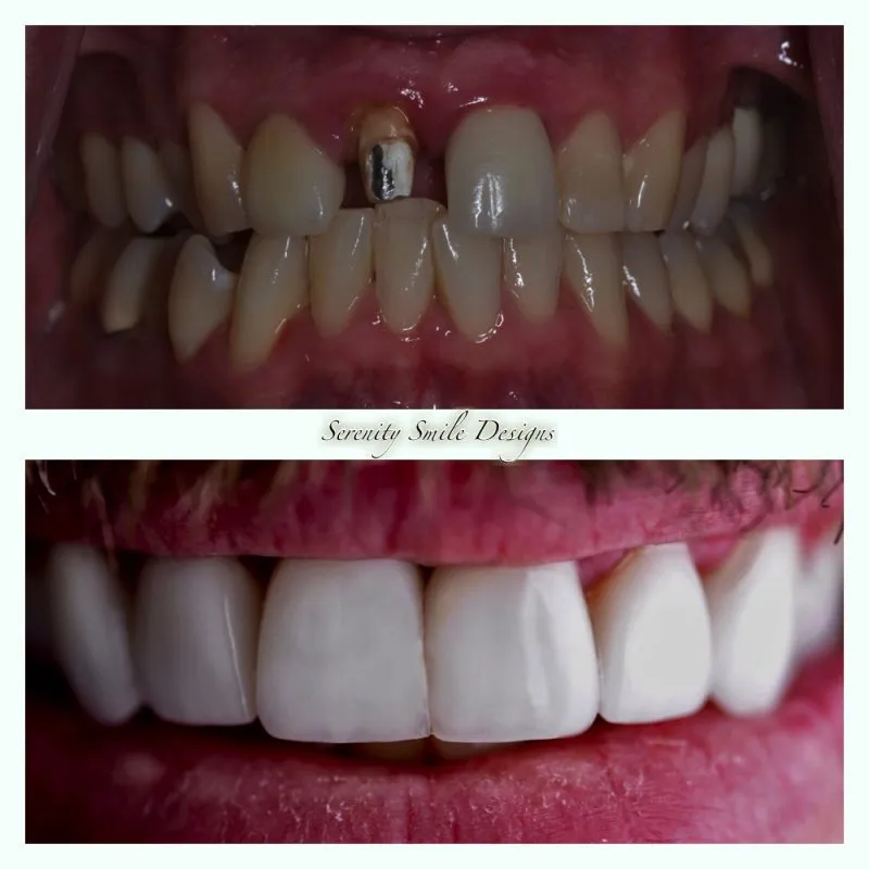 Antes y después de comparación de dientes que muestran implantes dentales y restauración completa.