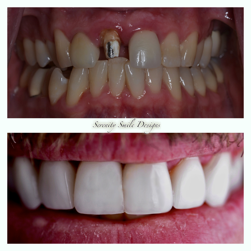 Before and after comparison of teeth showing dental implants and full restoration