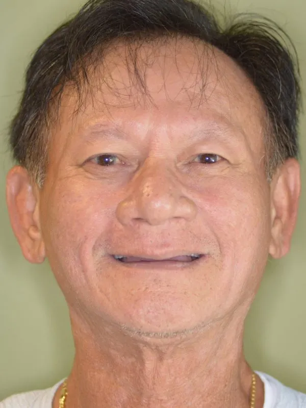 hombre antes de los implantes dentales