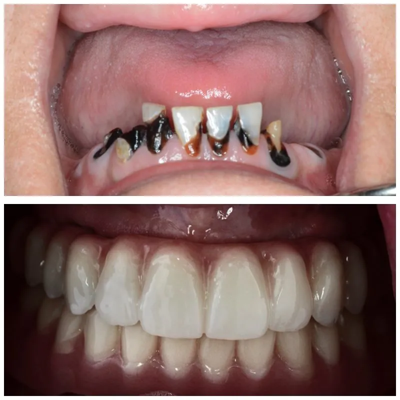 Galería de sonrisa antes y después de la foto