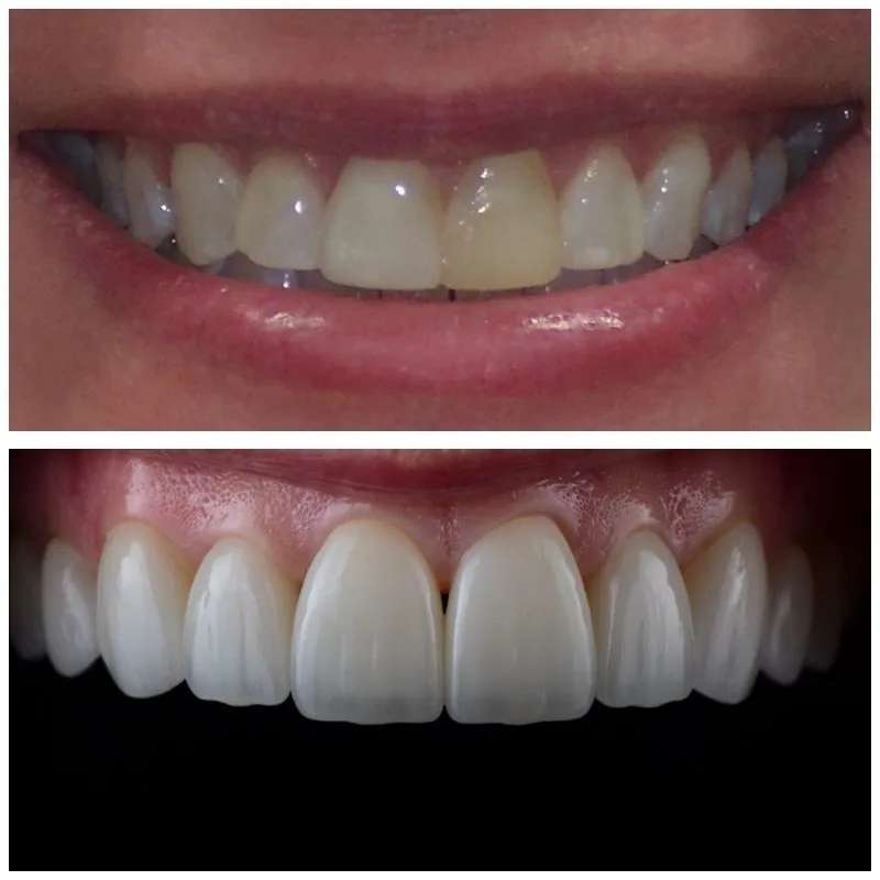 galería de sonrisas - antes y después